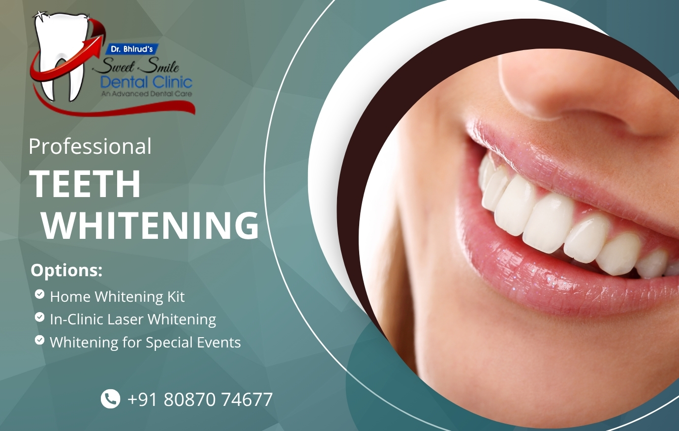 Teeth Whitening at Sweet Smile Dental Clinic